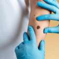Choose A Skin Cancer Oncologist For Expert Lump And Bump Care
