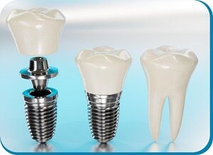 Ahmedabad, Health, Best Dental Implant In Ahmedabad