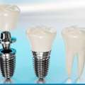 Best Dental Implant In Ahmedabad
