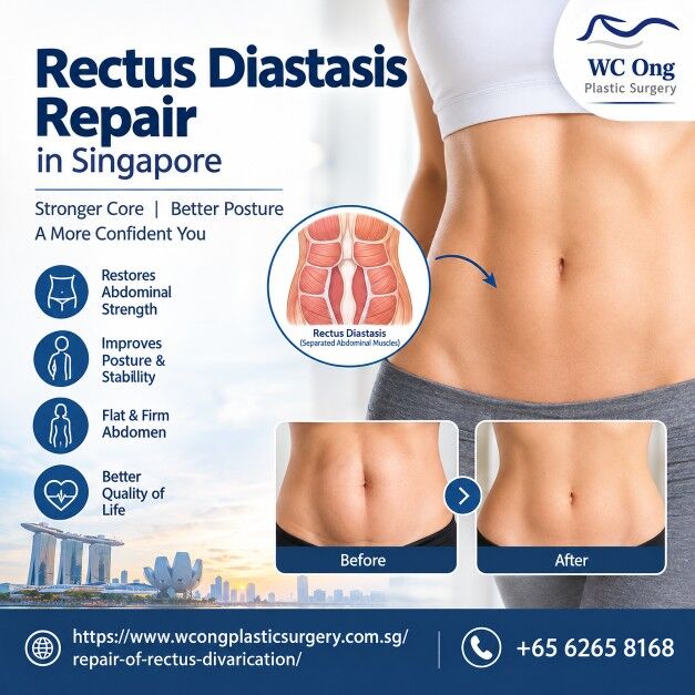 Singapore, Health, Book A Consultation For Rectus Diastasis Repair In Singapore