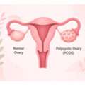 Best PCOD Treatment In Delhi