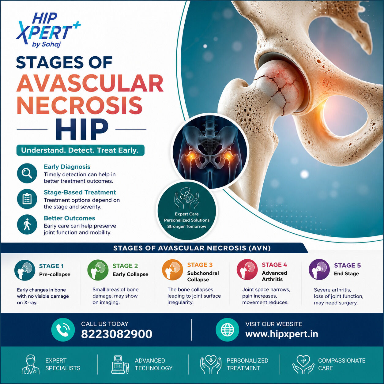 Indore, Health, Stages Of Avascular Necrosis Hip - HipXpert