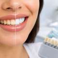 Yellow Teeth To Brighter Smiles: What Really Works?