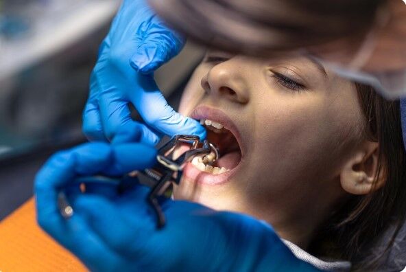 Mumbai, Health, How To Understand Tooth Transplant Cost In Kandivali