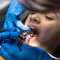 How To Understand Tooth Transplant Cost In Kandivali