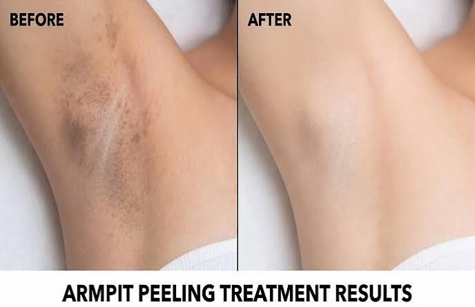 Dubai, Dental, Underarm Chemical Peel Treatment In Dubai