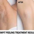 Underarm Chemical Peel Treatment In Dubai