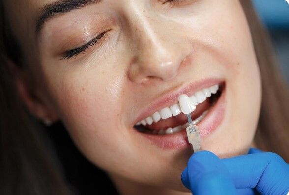 Mumbai, Health, Best Veneers In Kandivali For Natural-Looking Teeth