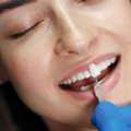 Best Veneers In Kandivali For Natural-Looking Teeth