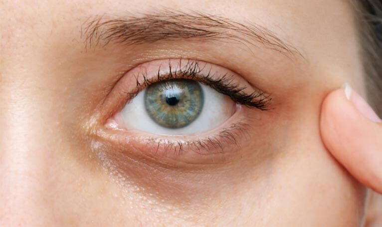 Al Nahda, Health, Say Goodbye To Dark Circles & Hollow Eyes: How PRP Therapy Revives Tired Eyes - AFFORD Cli