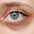 Say Goodbye To Dark Circles & Hollow Eyes: How PRP Therapy Revives Tired Eyes - AFFORD Cli