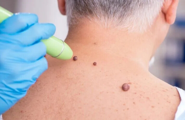 New York, Health, Wart Treatment Near Me From Trusted Dermatology Specialists