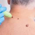 Wart Treatment Near Me From Trusted Dermatology Specialists