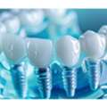 All On 4 Dental Implants And Porcelain Veneers For A Confident Somerset Smile