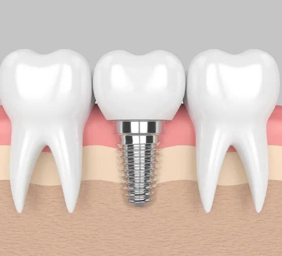 Madurai, Dental, Invisalign Treatment In Madurai
