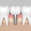 Invisalign Treatment In Madurai