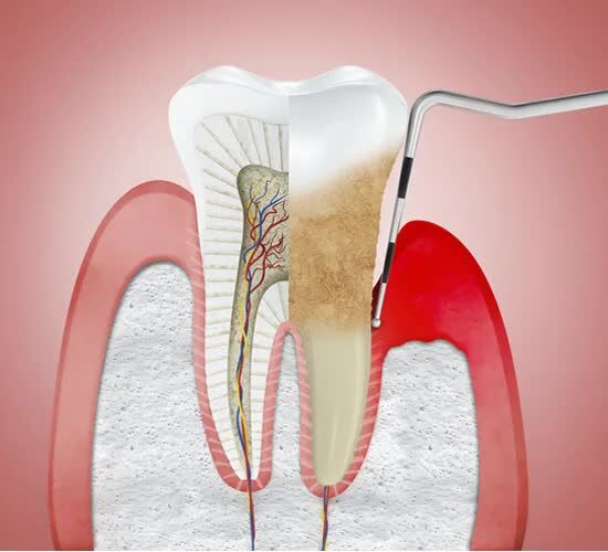 Madurai, Dental, Invisalign Treatment In Madurai