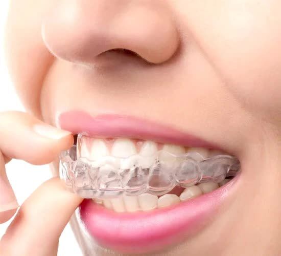 Madurai, Dental, Invisalign Treatment In Madurai