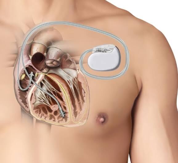 Dubai, Health, Advanced Pacemaker Treatment For Heart Rhythm Disorders