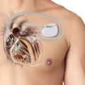 Advanced Pacemaker Treatment For Heart Rhythm Disorders