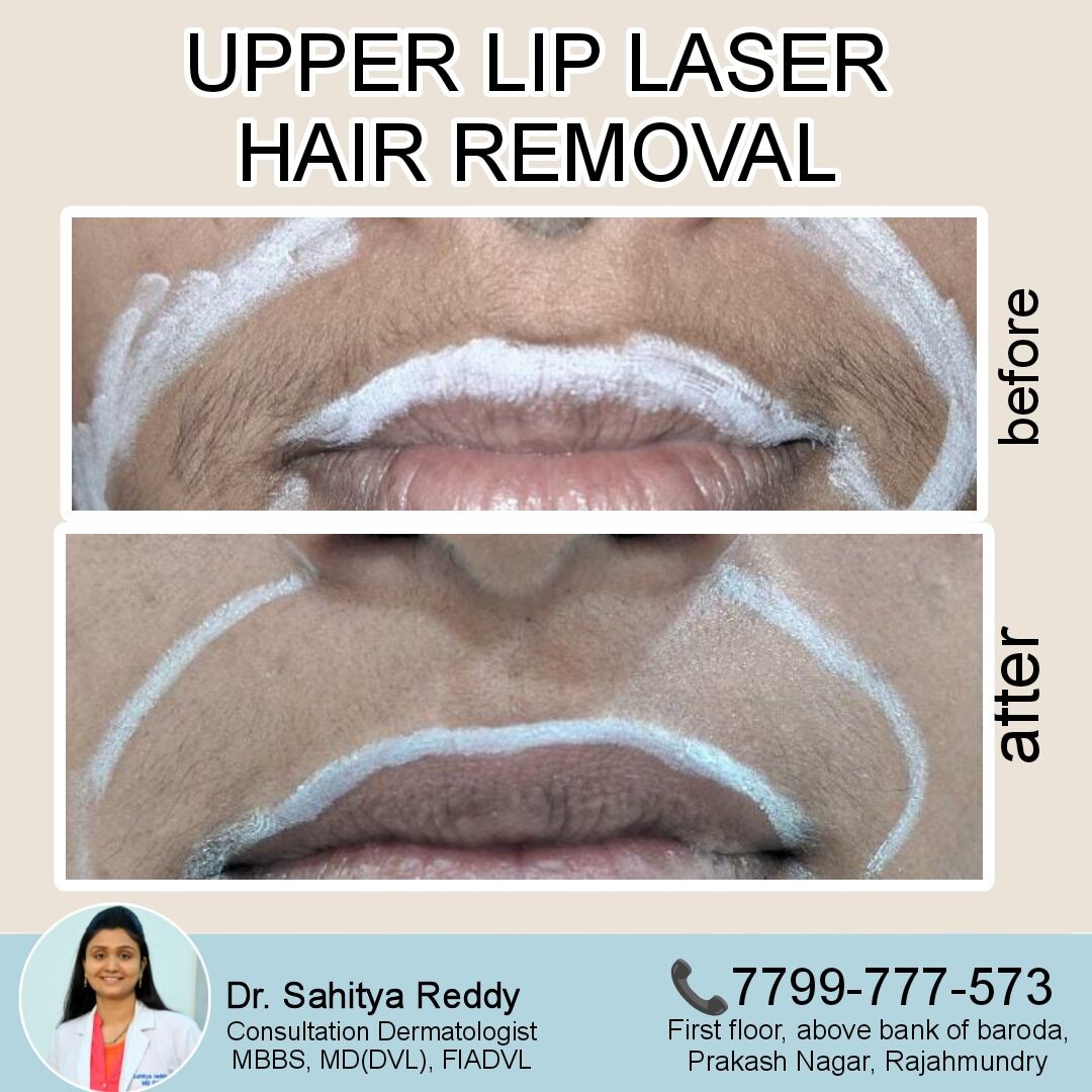 Kurnool, Health, Best Results For Upper Lip Hair - Dermacure