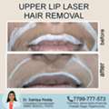 Best Results For Upper Lip Hair - Dermacure