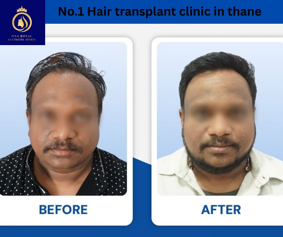 Thane, Fashion & Design, No. 1 Hair Transplant & Hair Restoration Clinic In Thane | DNA Royal.