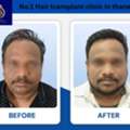 No. 1 Hair Transplant & Hair Restoration Clinic In Thane | DNA Royal.