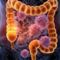 Colon Cancer Doctor In Noida For Early Detection & Care