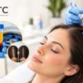 Female Hair Transplant Services