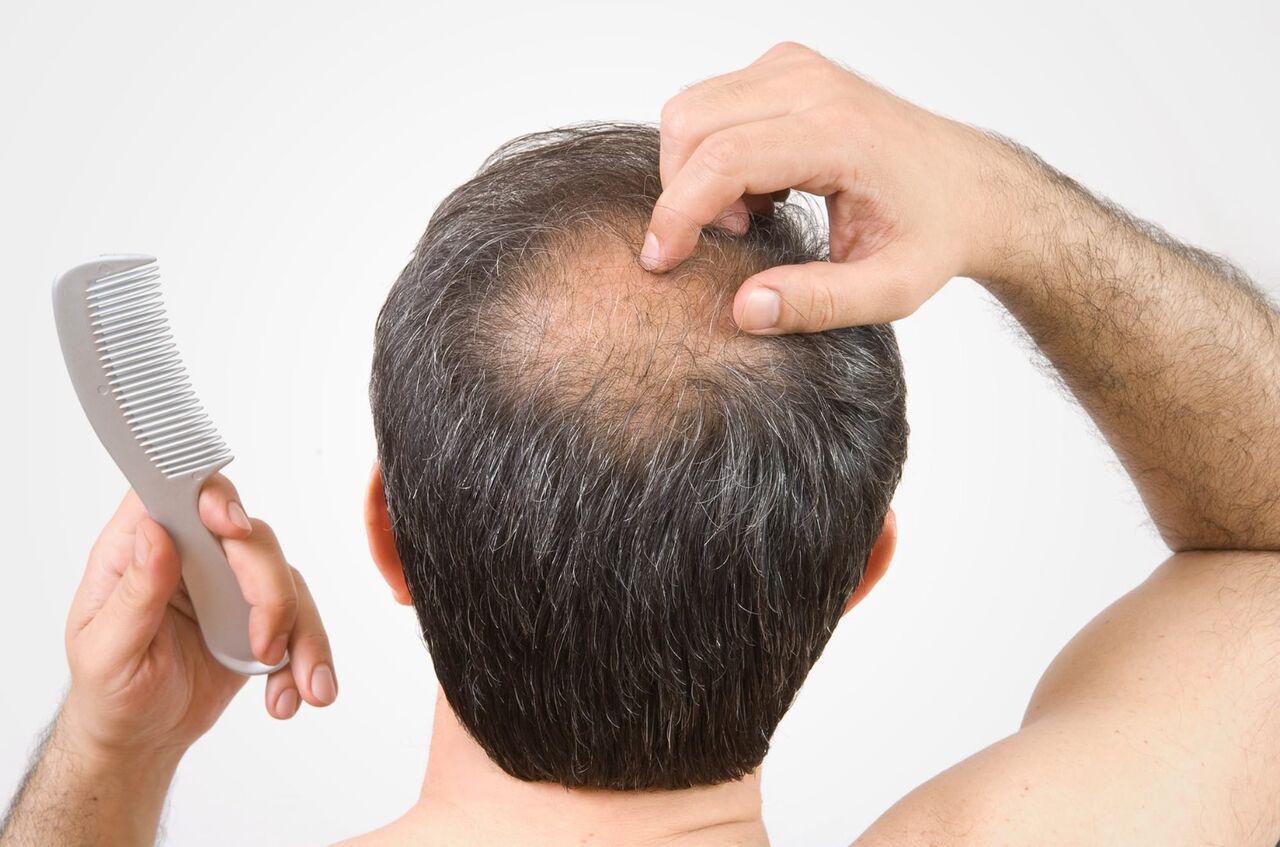 Gurgaon, Health, Hair Loss Treatment In Gurgaon &ndash; Citrine Clinic