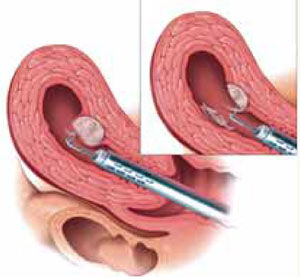 New Delhi, Health, Microtese In Delhi For Severe Male Infertility | Fertylity IVF