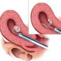 Microtese In Delhi For Severe Male Infertility | Fertylity IVF