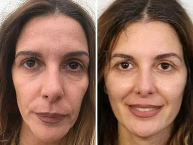 Cape Town, Health, Get Rid Of Wrinkles And Rejuvenate Your Face With A Personalised Facelift Cape Town.