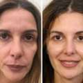 Get Rid Of Wrinkles And Rejuvenate Your Face With A Personalised Facelift Cape Town.