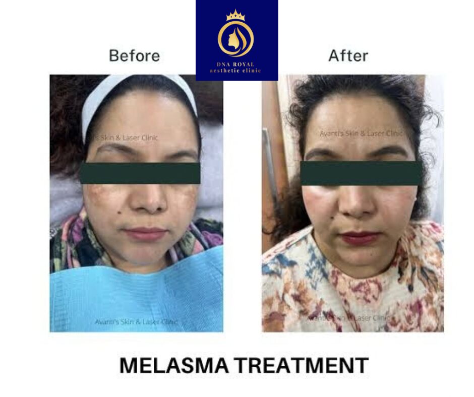 Thane, Fashion & Design, Best Melasma Treatment In Thane &ndash; Advanced Skin Care At DNA Royal