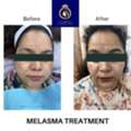 Best Melasma Treatment In Thane &ndash; Advanced Skin Care At DNA Royal