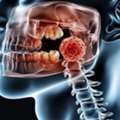 Advanced Oral Cancer Treatment With Comprehensive Patient Support