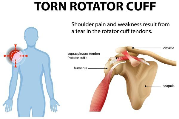 New York, Medical, Rotator Cuff Surgery Recovery Guide &ndash; What To Expect