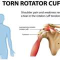 Rotator Cuff Surgery Recovery Guide &ndash; What To Expect