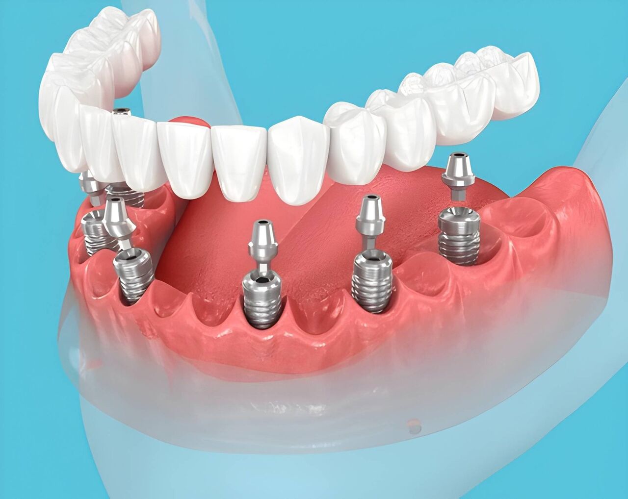 Miami, Dental, Prosthodontics Miami FL &mdash; Advanced Smile Restoration