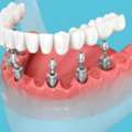Prosthodontics Miami FL &mdash; Advanced Smile Restoration