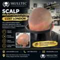 Scalp Micropigmentation Cost London | SMP For Hair