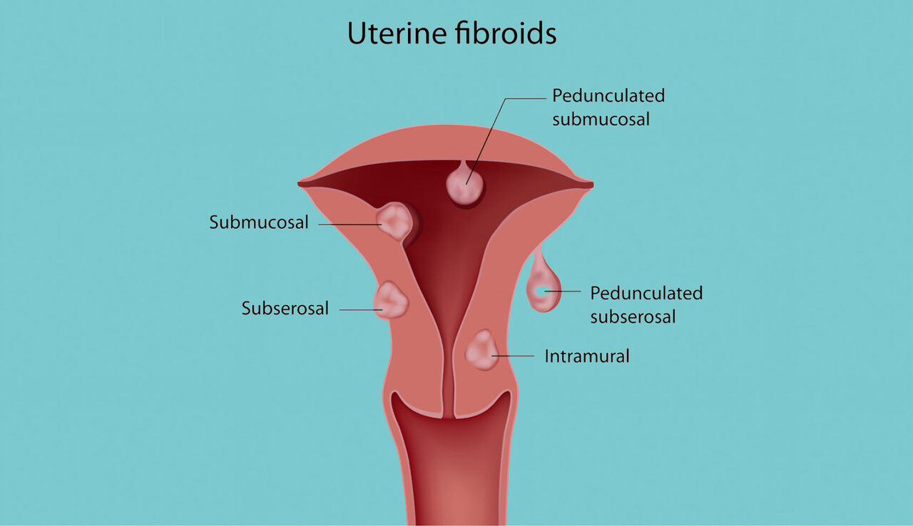 New Delhi, Health, Best Uterine Evaluation In Delhi For Fertility Success | Fertylity IVF