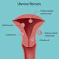 Best Uterine Evaluation In Delhi For Fertility Success | Fertylity IVF