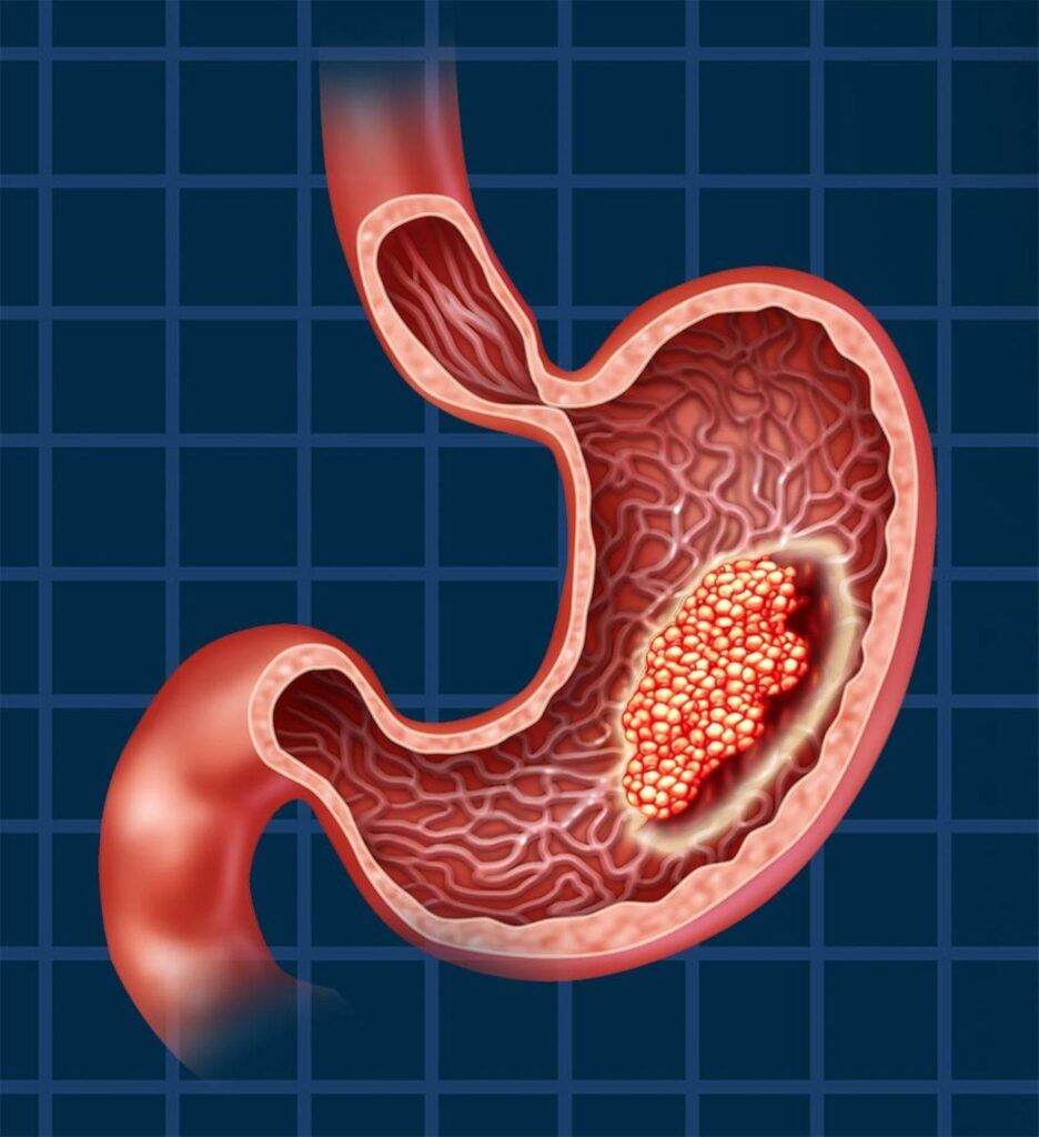 Ghaziabad, Health, Expert Solutions For Stomach Cancer Treatment In Noida