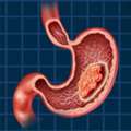 Expert Solutions For Stomach Cancer Treatment In Noida