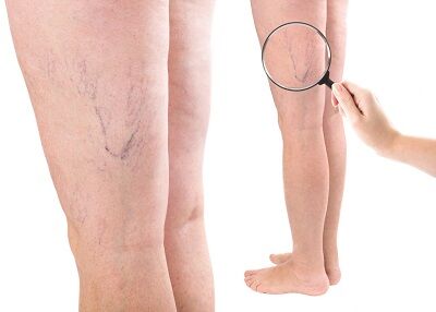 Toronto, Health, Vein Health Clinic Etobicoke