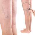 Vein Health Clinic Etobicoke