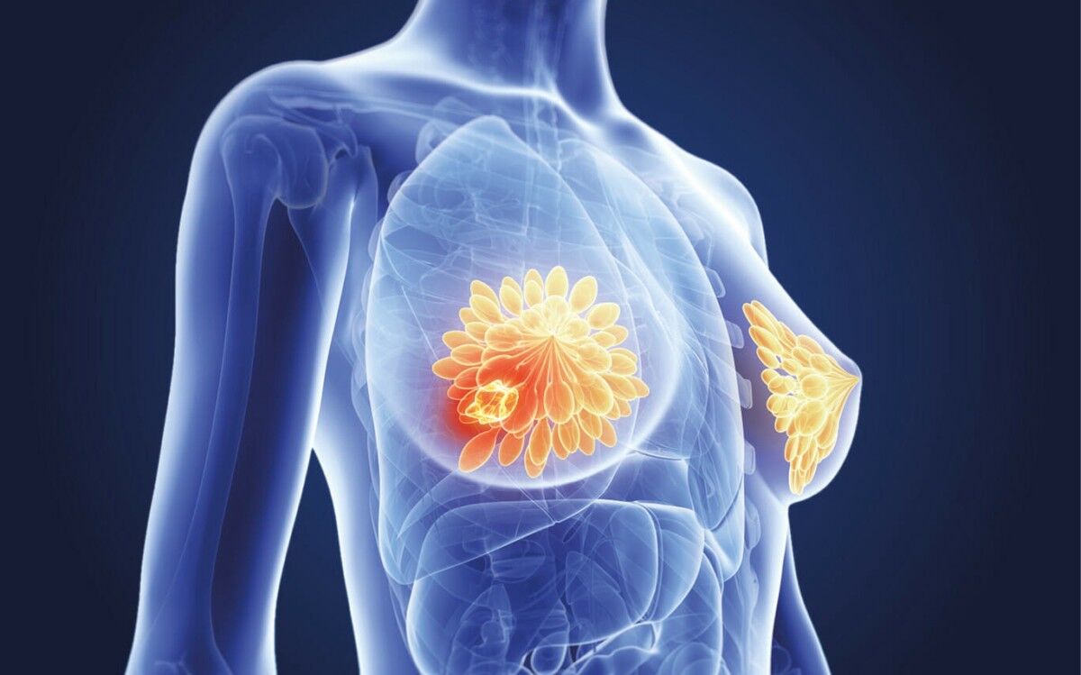 Ghaziabad, Health, Best Breast Cancer Treatment In Noida By Dr Manish Singhal